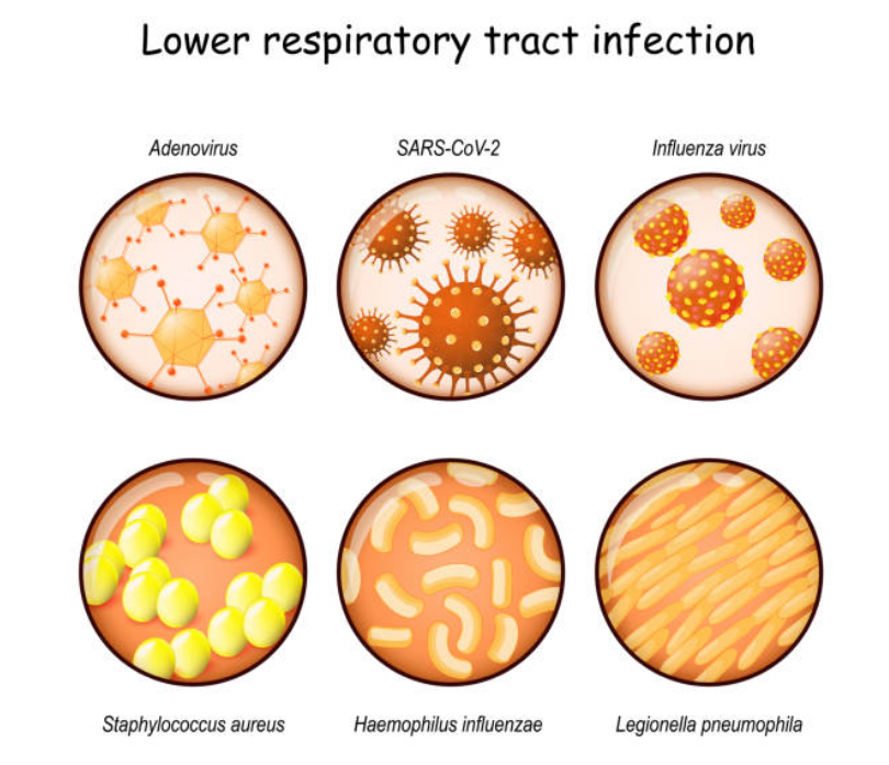 اسباب التهاب الجهاز التنفسي السفلي